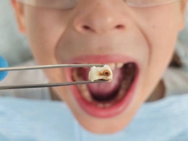Best Emergency Dental Care for Abscessed Tooth in Burlington, NC